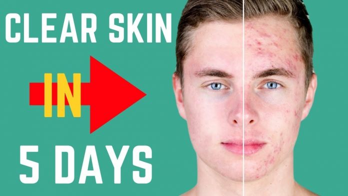 How to get Clear skin?
