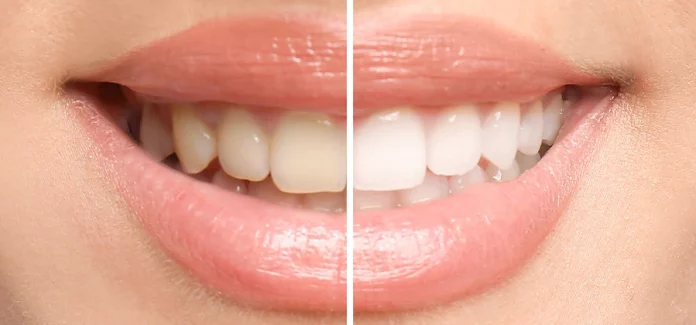 How to whiten teeth?